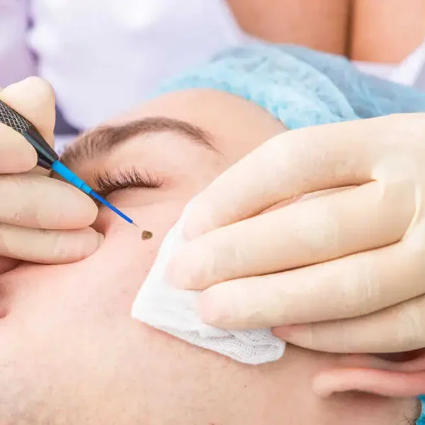 Electrocautery-by-Carnelian-Medspa-and-Wellness-in-Allen-TX