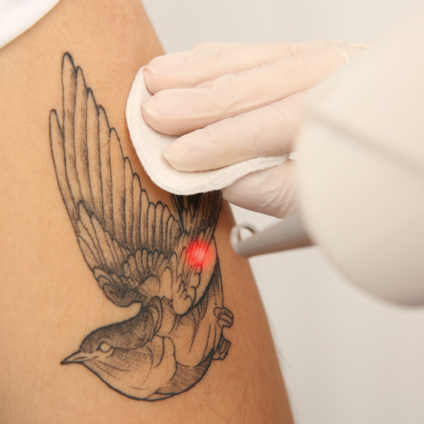 Laser-Tattoo-Removal-Image